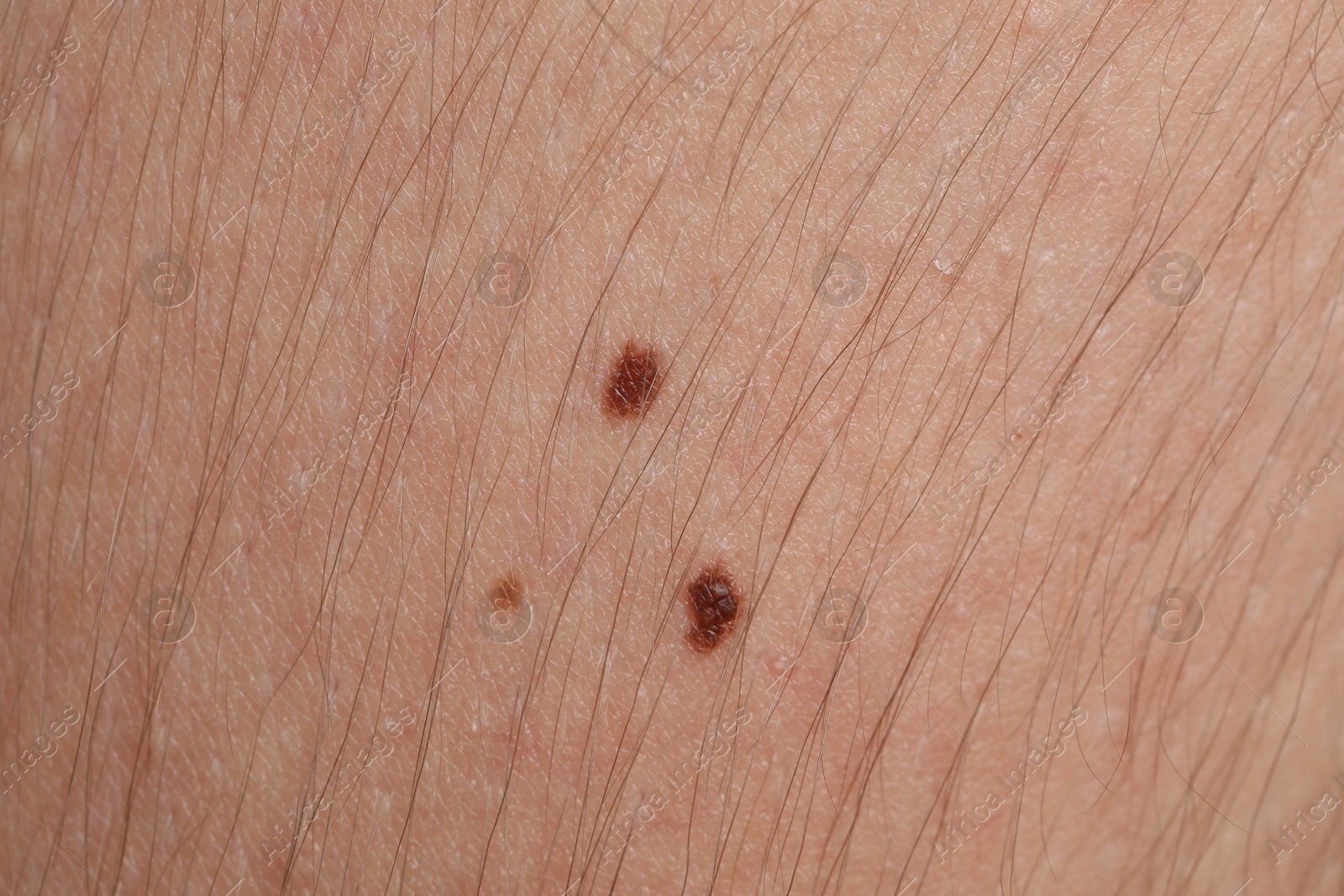 Photo of Woman with moles on her body, closeup