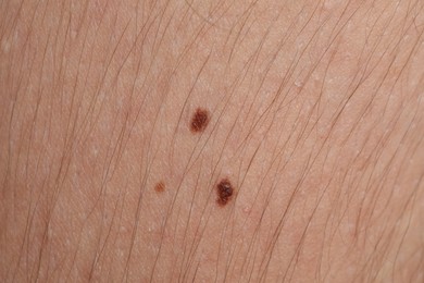 Photo of Woman with moles on her body, closeup
