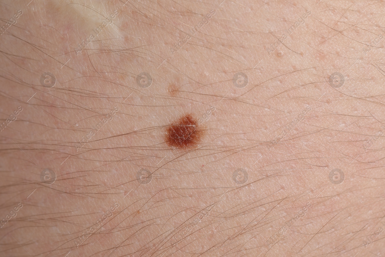 Woman with mole on her body, closeup Photo of Woman with mole on her body, closeup