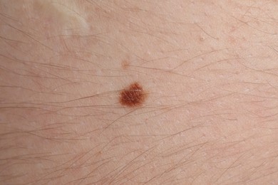 Photo of Woman with mole on her body, closeup