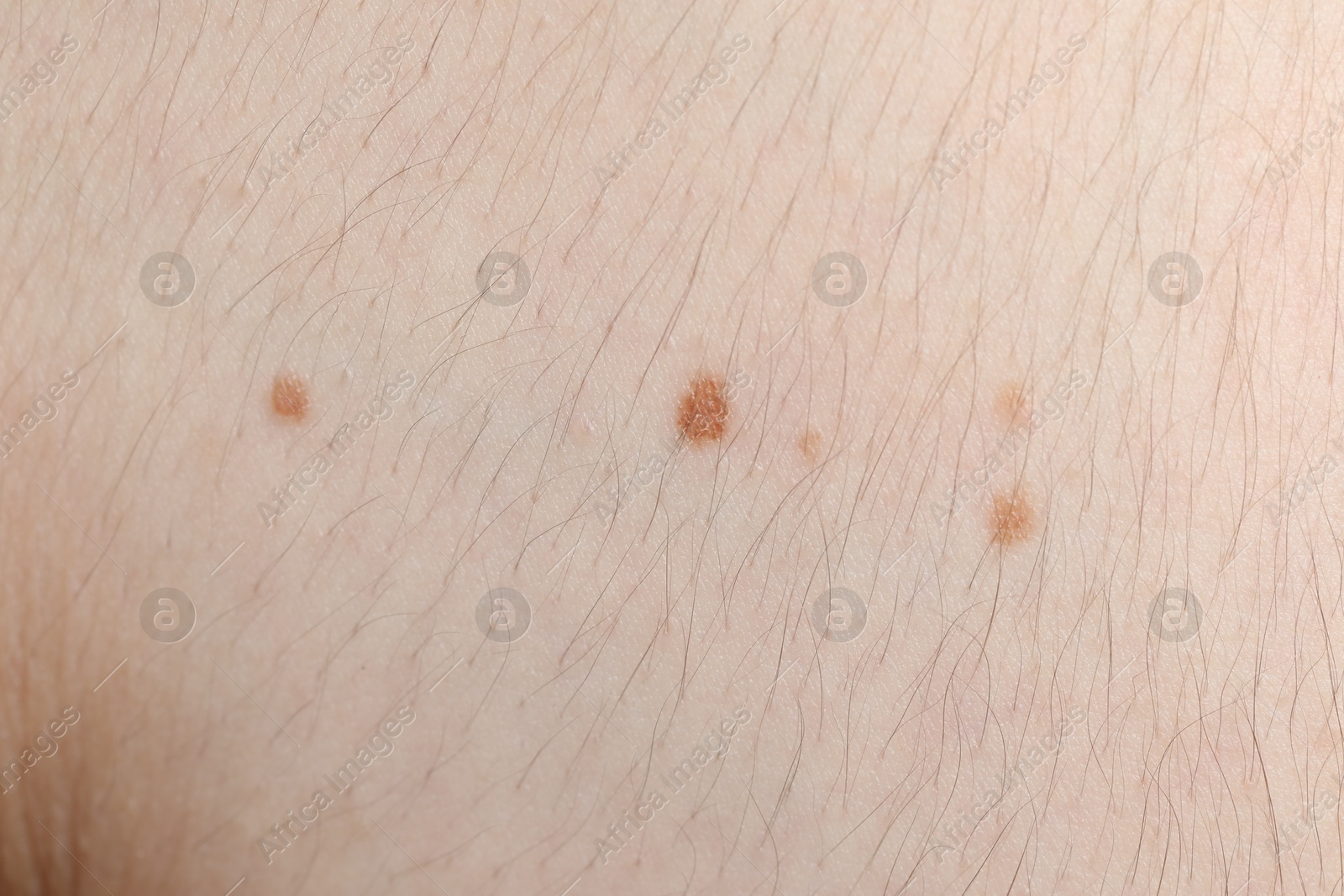 Woman with moles on her body, closeup Photo of Woman with moles on her body, closeup