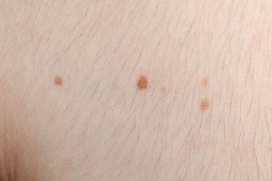 Photo of Woman with moles on her body, closeup