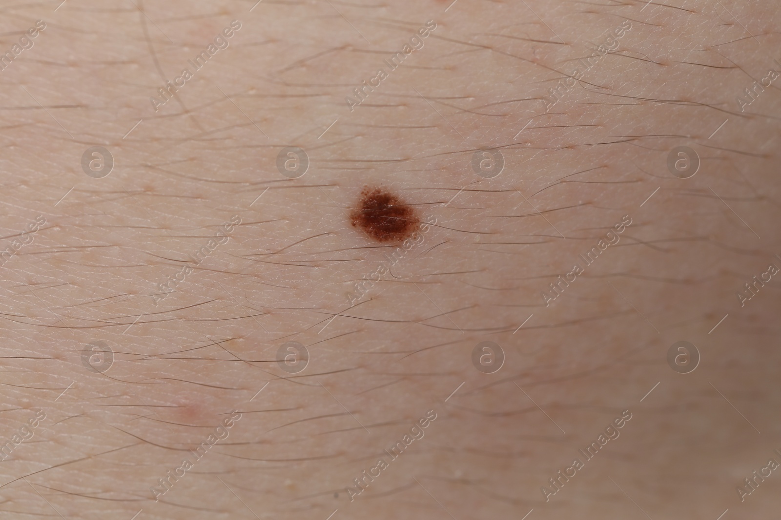 Man with mole on his body, closeup Photo of Man with mole on his body, closeup