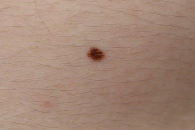 Photo of Man with mole on his body, closeup