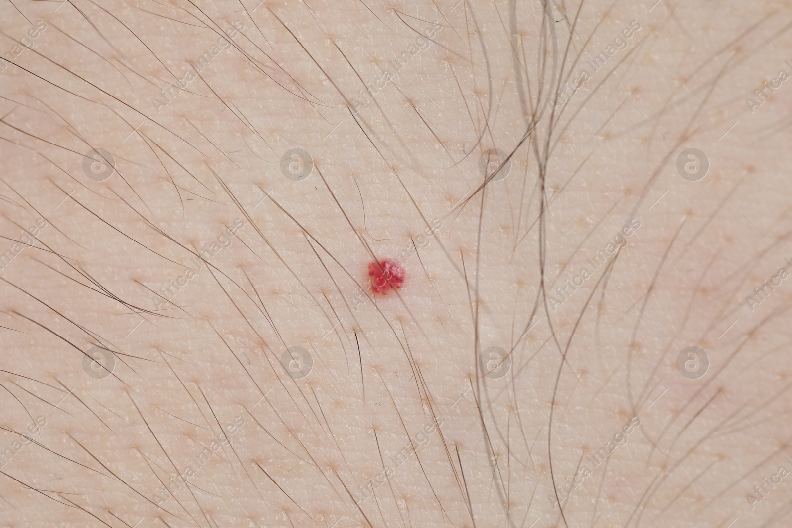 Man with mole on his body, closeup Photo of Man with mole on his body, closeup