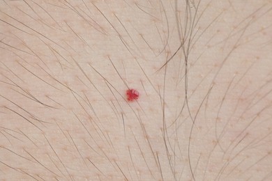 Photo of Man with mole on his body, closeup