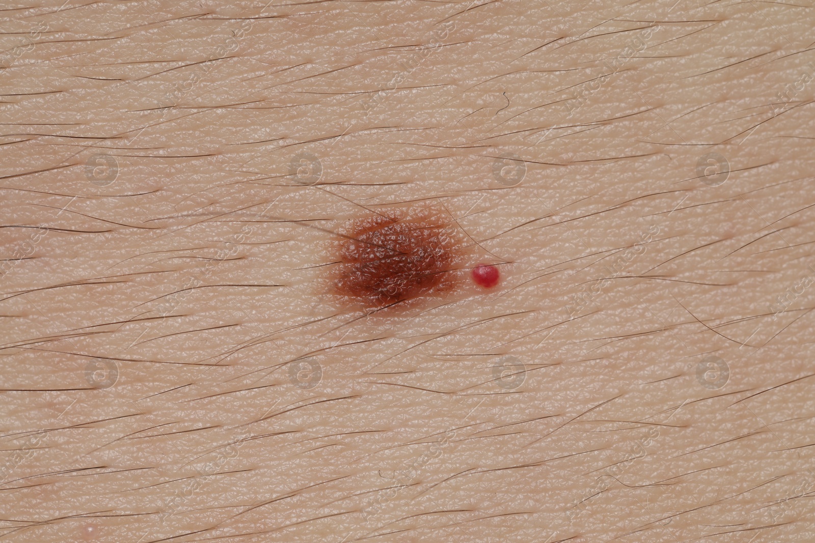 Man with moles on his body, closeup Photo of Man with moles on his body, closeup