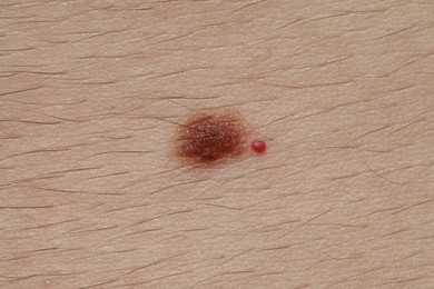Photo of Man with moles on his body, closeup