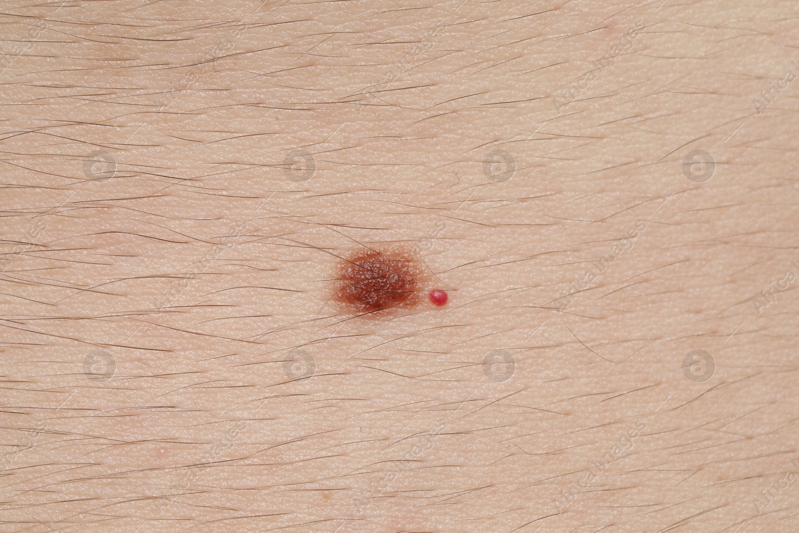 Man with moles on his body, closeup Photo of Man with moles on his body, closeup