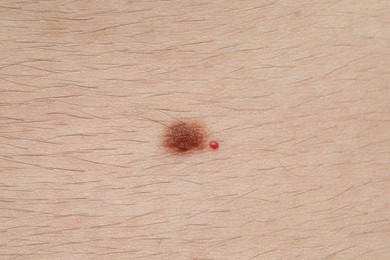 Photo of Man with moles on his body, closeup