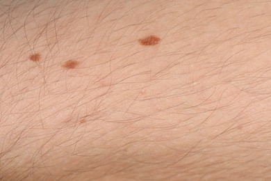 Photo of Man with moles on his body, closeup