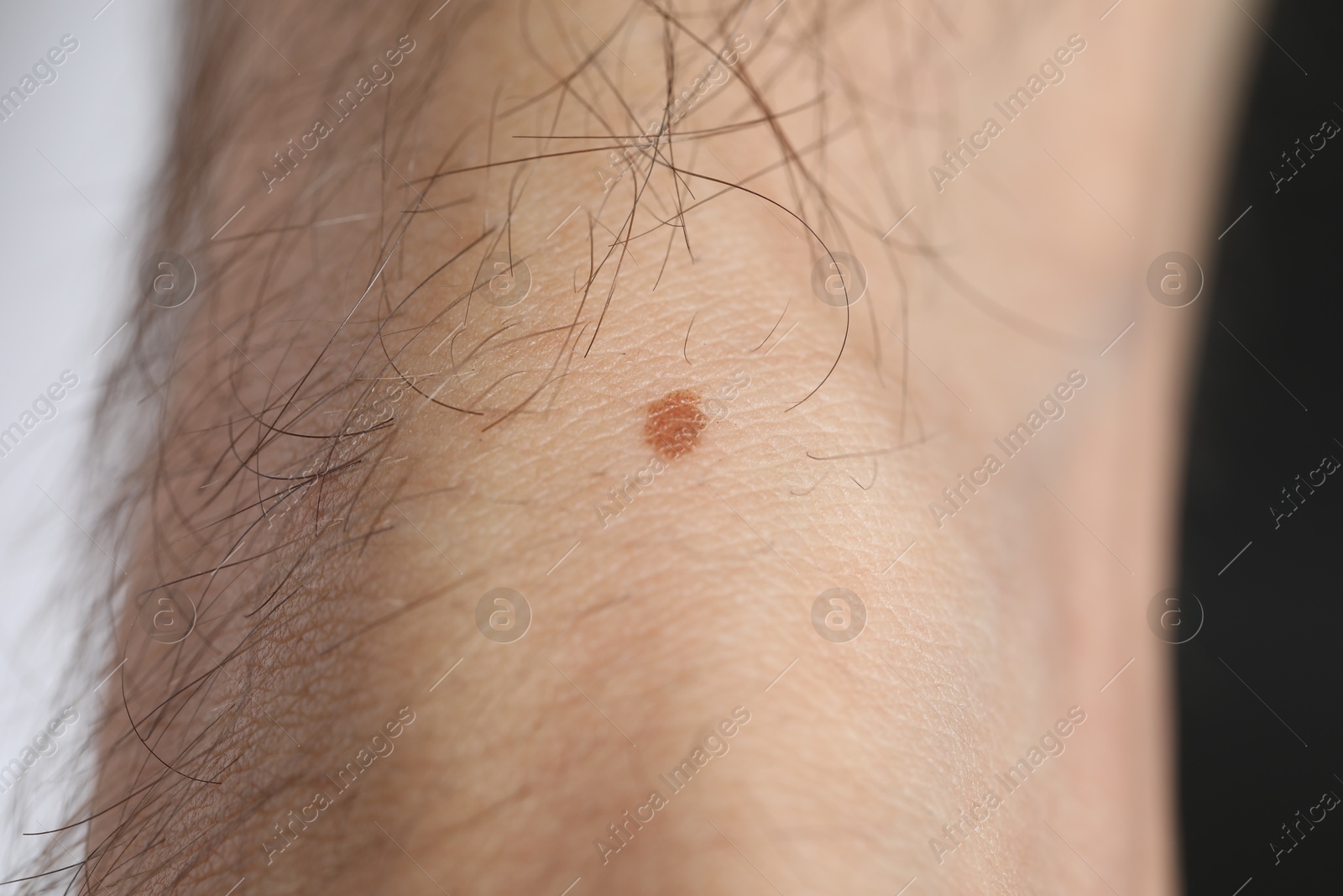 Man with mole on his body against dark background, closeup Photo of Man with mole on his body against dark background, closeup