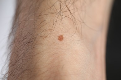 Photo of Man with mole on his body against dark background, closeup