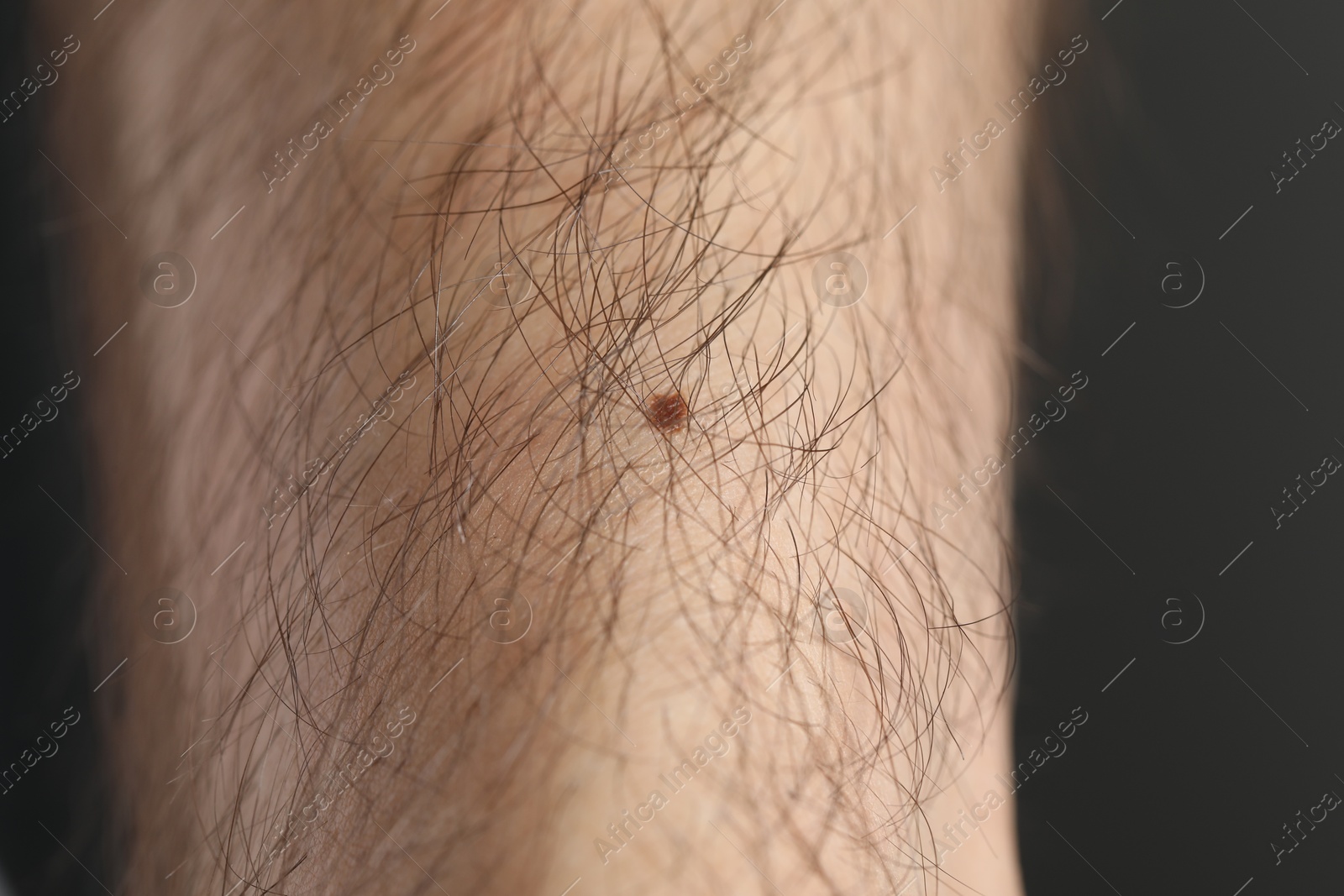 Man with mole on his body against dark grey background, closeup Photo of Man with mole on his body against dark grey background, closeup