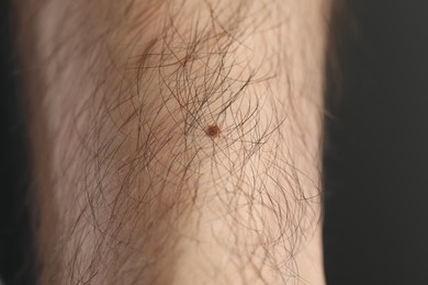 Photo of Man with mole on his body against dark grey background, closeup
