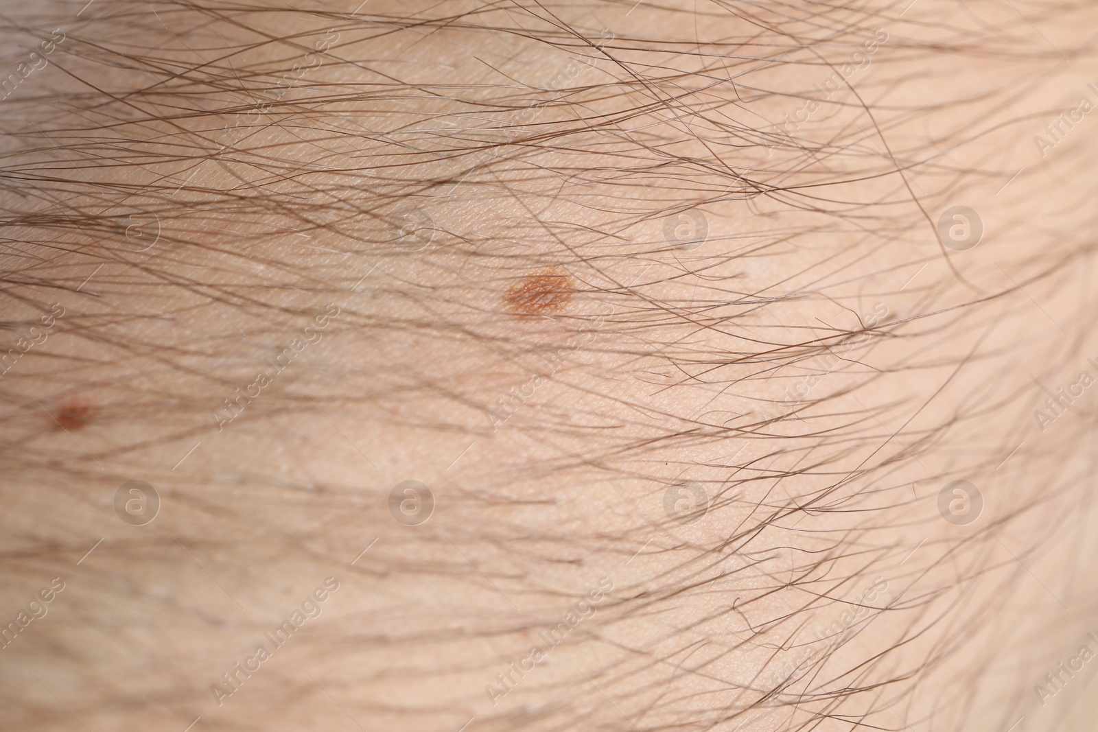 Photo of Man with moles on his body, closeup