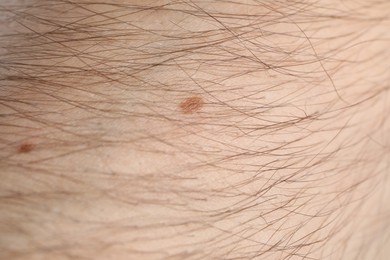 Photo of Man with moles on his body, closeup