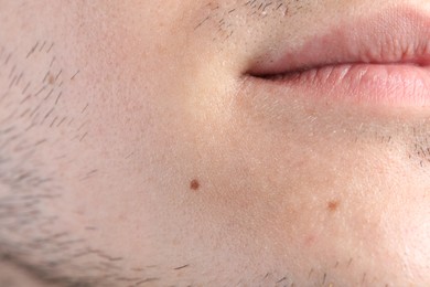 Photo of Man with moles on his face, closeup