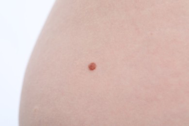 Photo of Woman with mole on her body against white background, closeup
