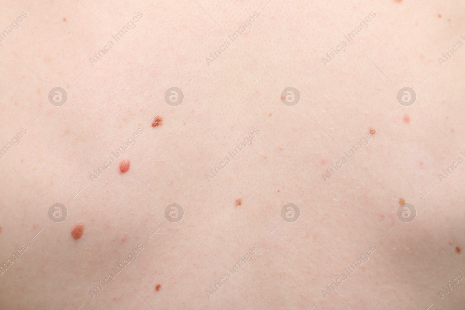 Woman with moles on her body, closeup Photo of Woman with moles on her body, closeup