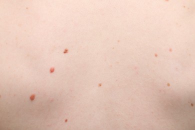 Photo of Woman with moles on her body, closeup