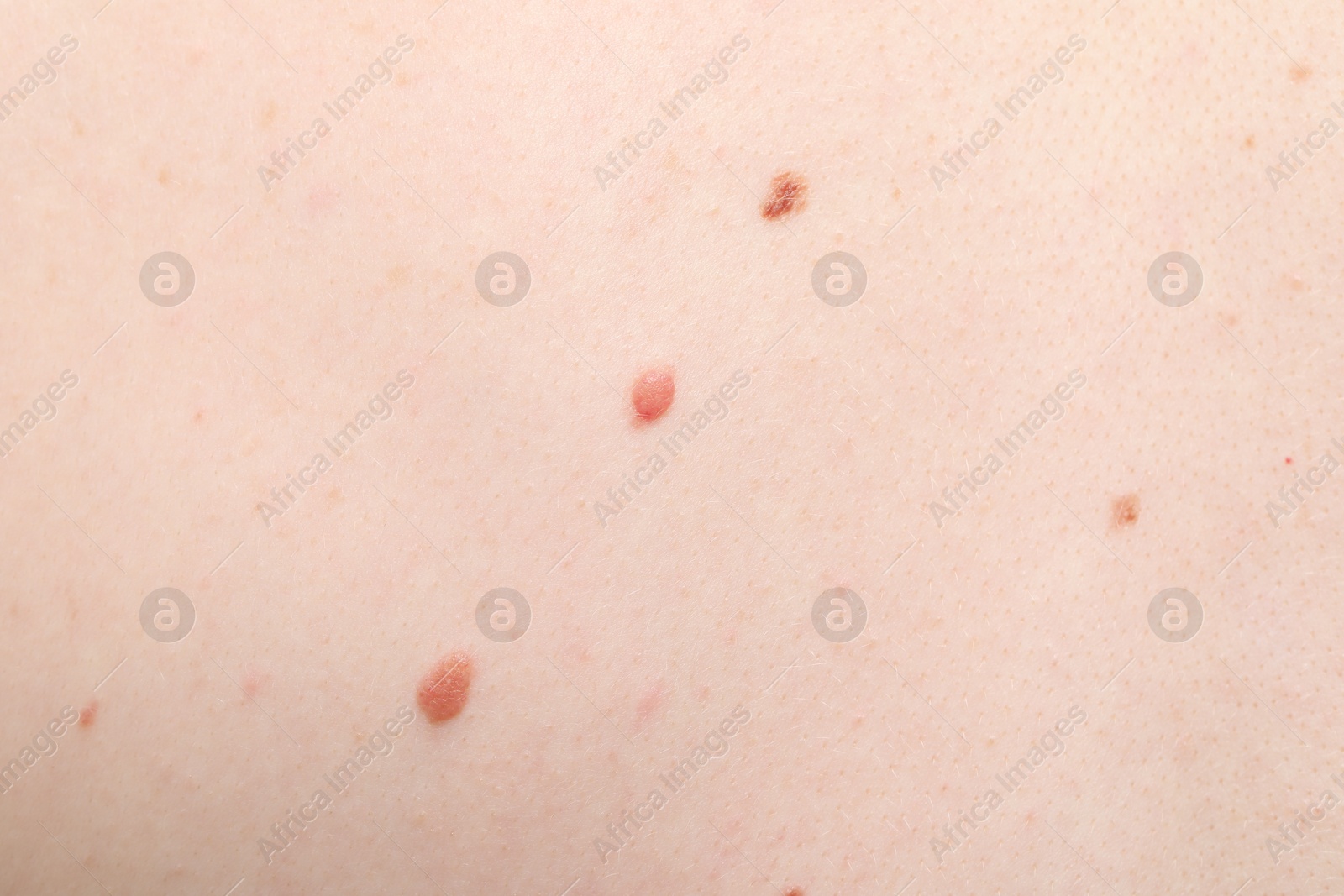 Woman with moles on her body, closeup Photo of Woman with moles on her body, closeup