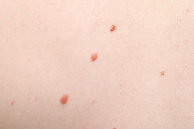 Photo of Woman with moles on her body, closeup