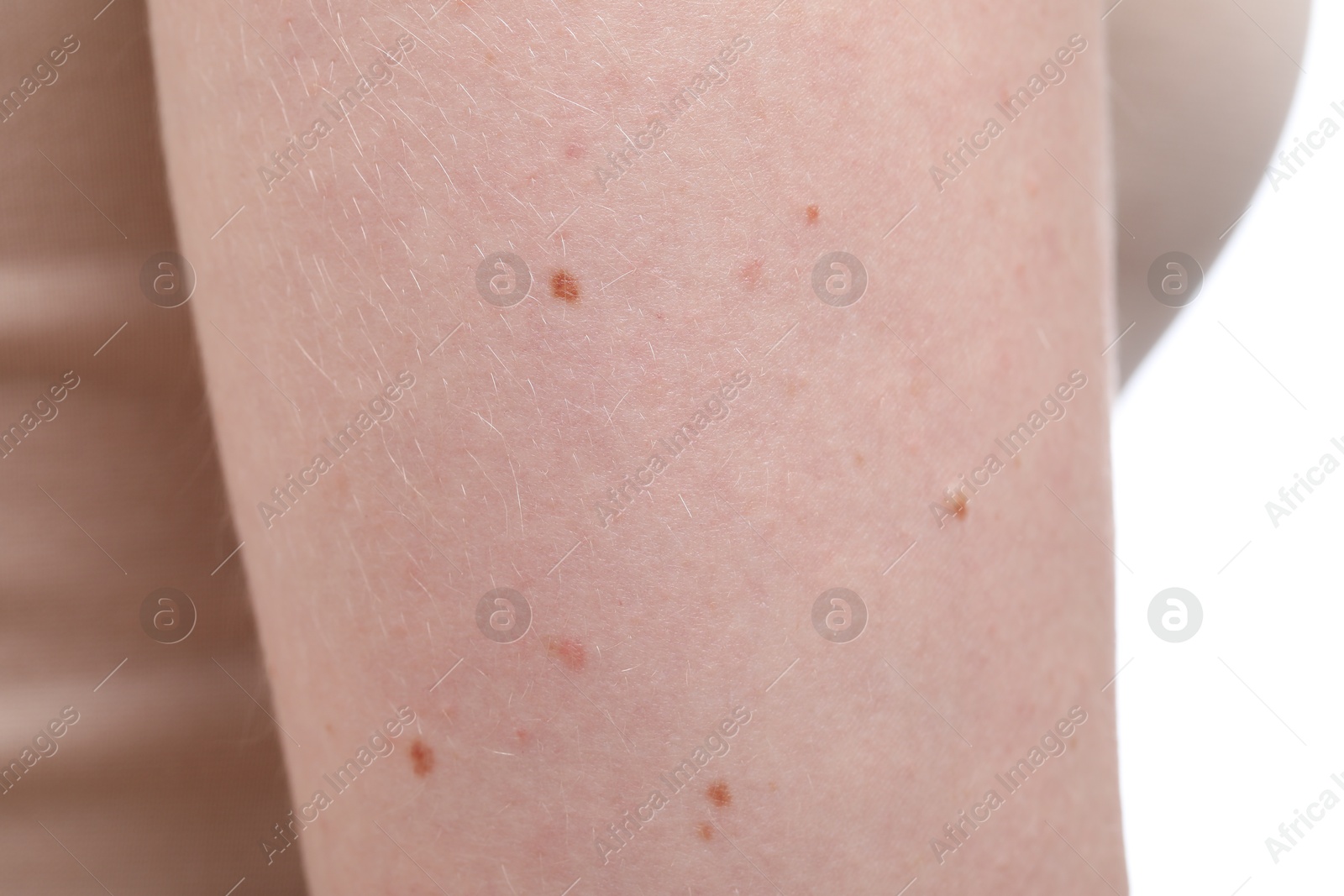 Woman with mole on her arm against white background, closeup Photo of Woman with mole on her arm against white background, closeup