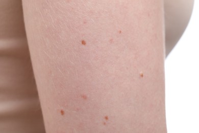 Photo of Woman with mole on her arm against white background, closeup