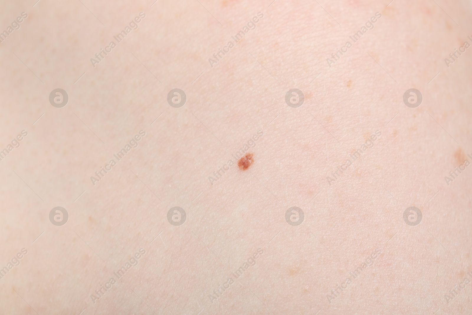 Woman with mole on her body, closeup Photo of Woman with mole on her body, closeup