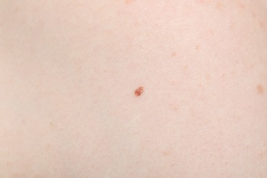 Photo of Woman with mole on her body, closeup