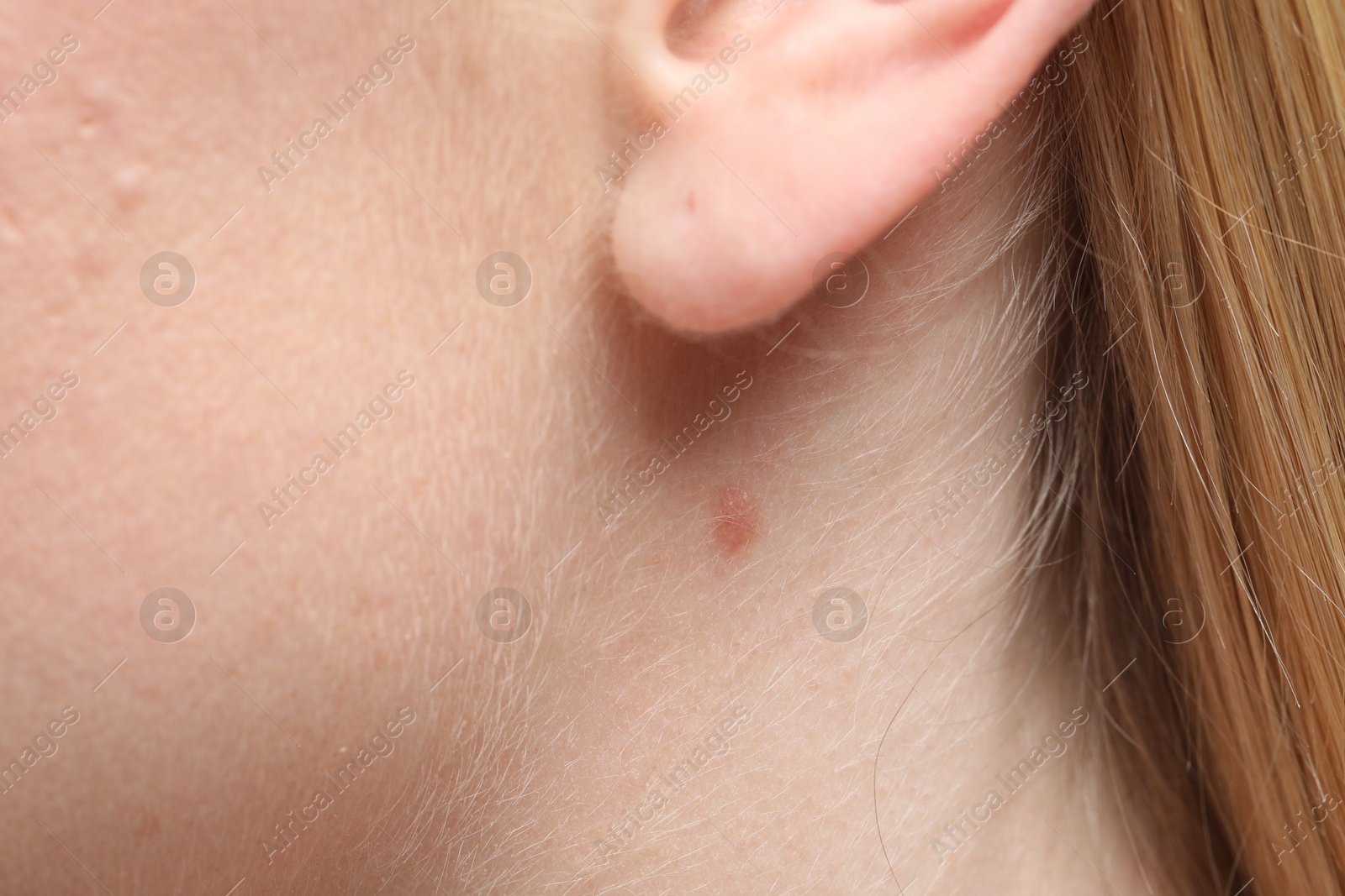 Woman with mole on her neck, closeup Photo of Woman with mole on her neck, closeup