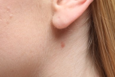 Photo of Woman with mole on her neck, closeup