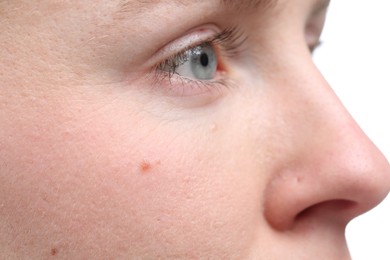 Photo of Woman with mole on her face against white background, closeup