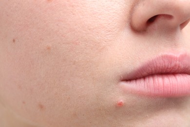 Photo of Woman with mole on her face, closeup