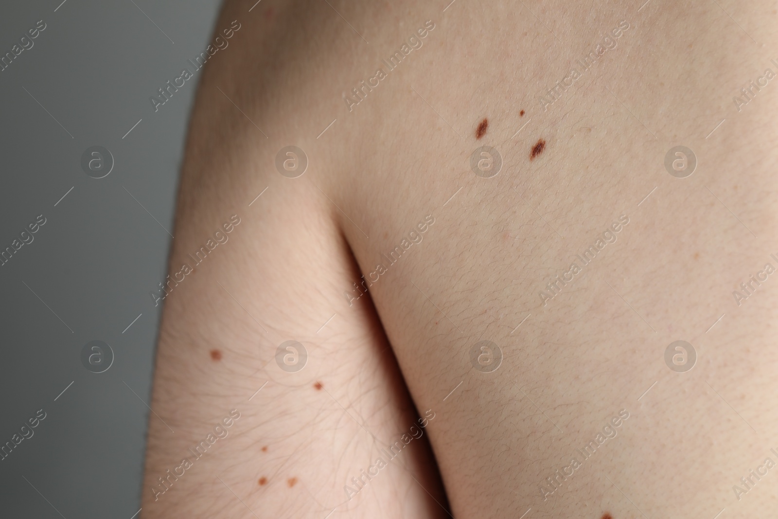 Man with moles on his body against grey background, closeup Photo of Man with moles on his body against grey background, closeup