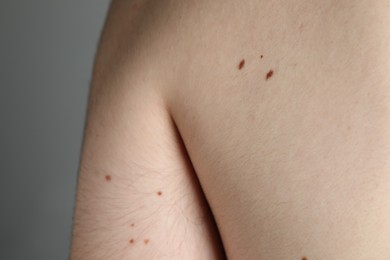 Photo of Man with moles on his body against grey background, closeup