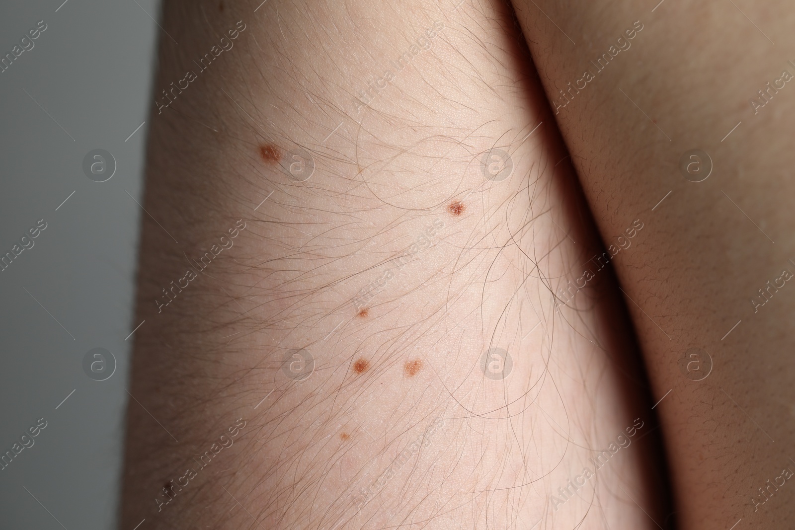 Man with moles on his body against grey background, closeup Photo of Man with moles on his body against grey background, closeup