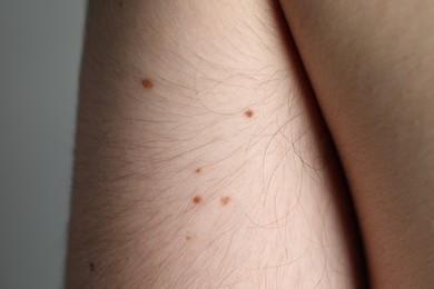 Photo of Man with moles on his body against grey background, closeup