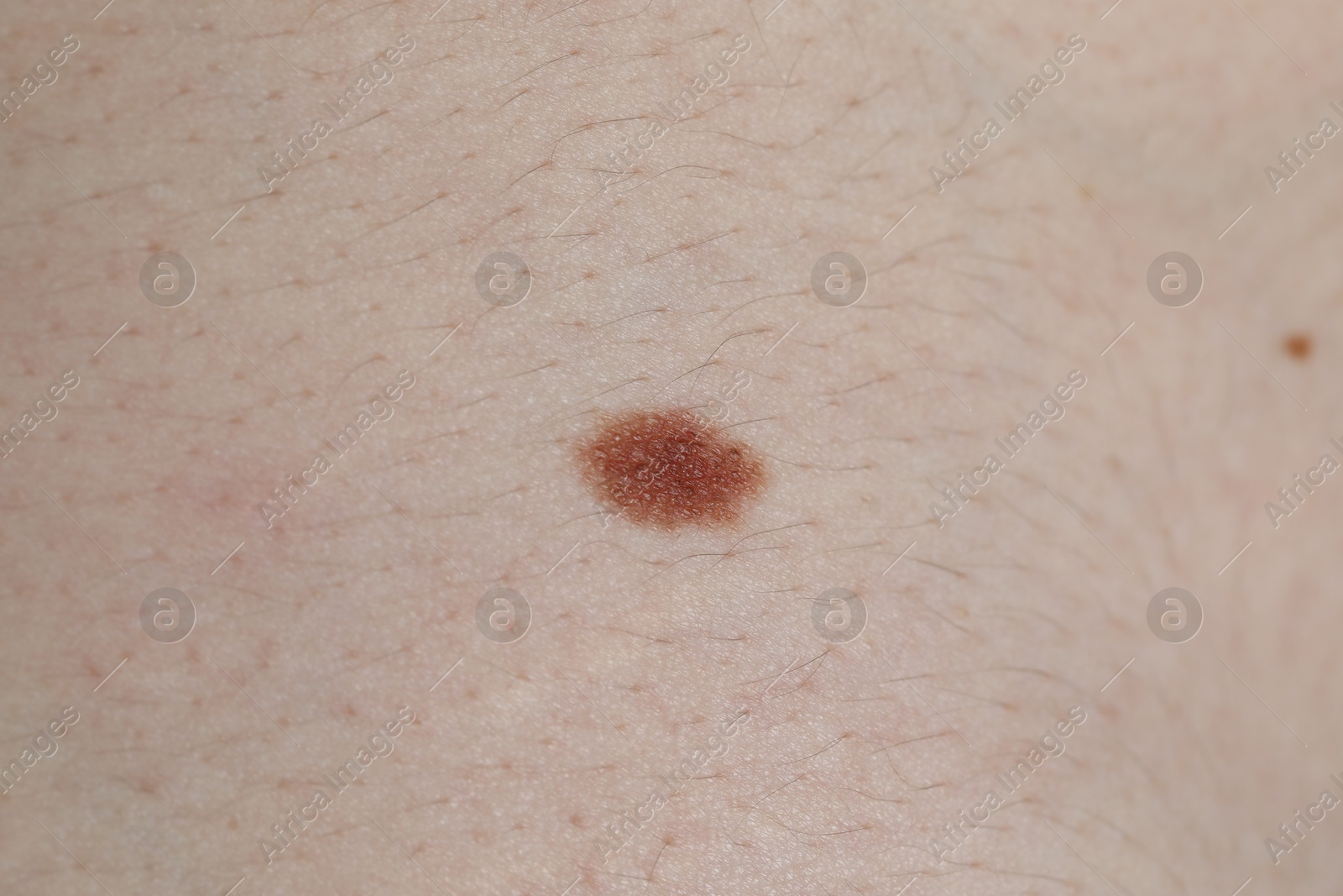 Photo of Man with moles on his body, closeup