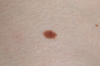 Photo of Man with moles on his body, closeup