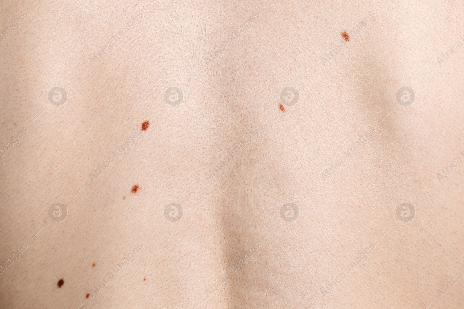 Man with moles on his body, closeup Photo of Man with moles on his body, closeup