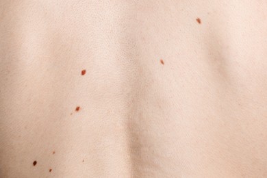 Photo of Man with moles on his body, closeup