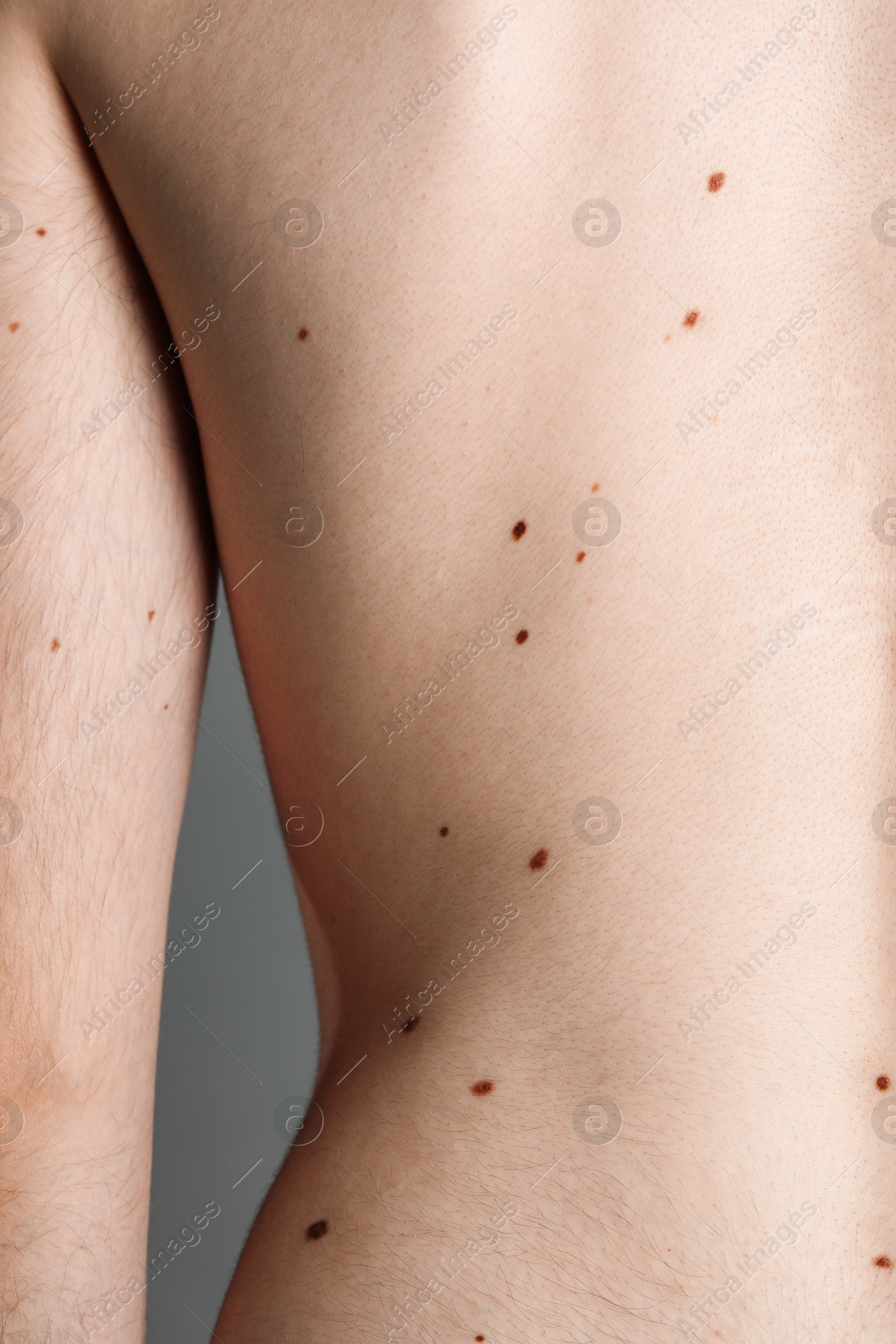 Photo of Man with moles on his body against grey background, closeup