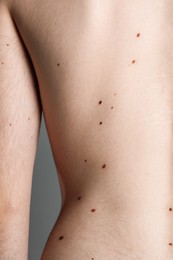 Photo of Man with moles on his body against grey background, closeup