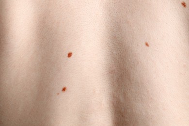 Photo of Woman with moles on her body, closeup