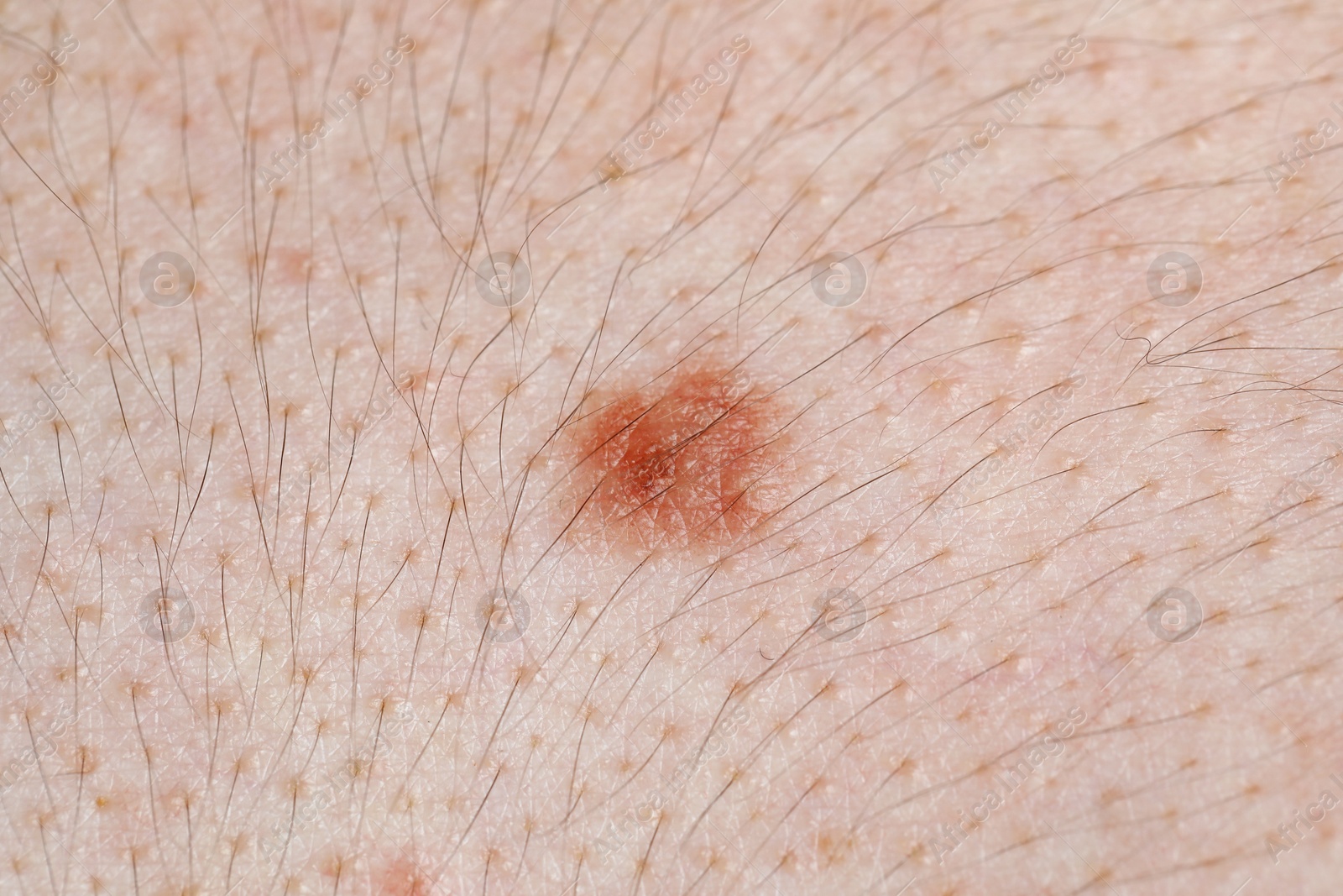 Woman with mole on her body, closeup Photo of Woman with mole on her body, closeup