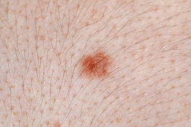Photo of Woman with mole on her body, closeup