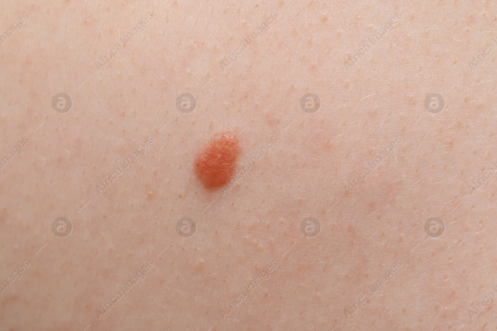 Woman with mole on her body, closeup Photo of Woman with mole on her body, closeup