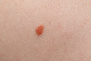 Photo of Woman with mole on her body, closeup